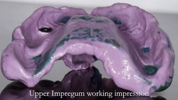 Newsletter 57 showcases the making and fitting process of implant-supported complete dentures for Alisdair