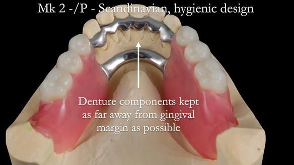 Newsletter 52 Managing Jo’s failing dentition with extractions and Mk 1/Mk 2 complete upper dentures and lower partial dentures FULL PROTOCOL