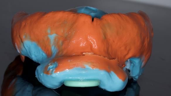 Newsletter 82 Mary - A complete upper and a one-tooth gasket denture