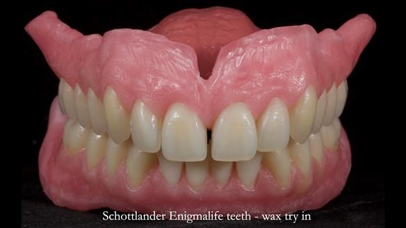 Newsletter 78: What do Clark Gable and a Locator® overdenture have in common?