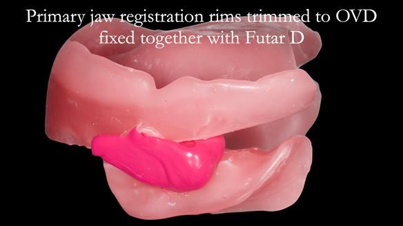 Newsletter 52 Managing Jo’s failing dentition with extractions and Mk 1/Mk 2 complete upper dentures and lower partial dentures FULL PROTOCOL