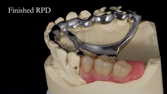 Finlay's Newsletter 64 case study - provision of a Kennedy class 2 metal based Scandinavian RPD for Ian