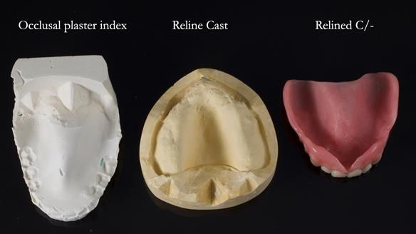 Newsletter 77: Jeremy’s case – immediate complete upper denture