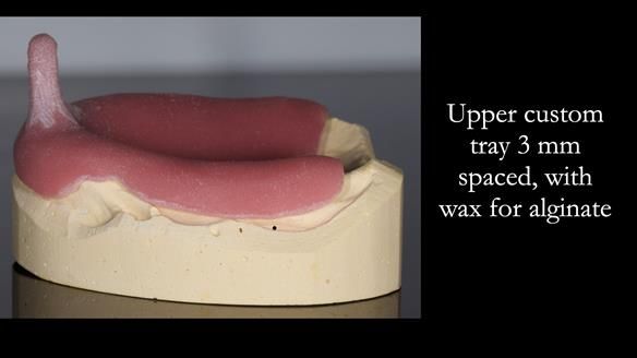 Managing poor implant positioning with complete dentures and Locator attachments - full protocol Newsletter 41