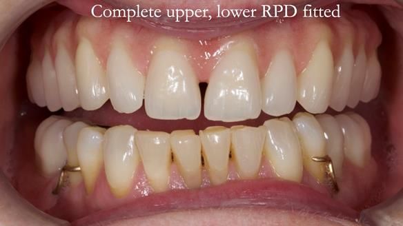 Solving Linda’s Failed “All on 4” implant bridges - full protocol Newsletter 42