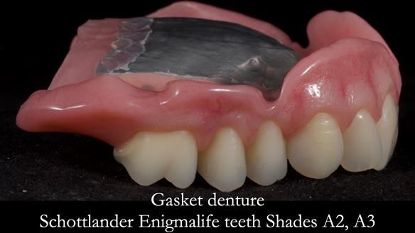 Finlay's Newsletter 58 Gasket upper partial denture for Zoe