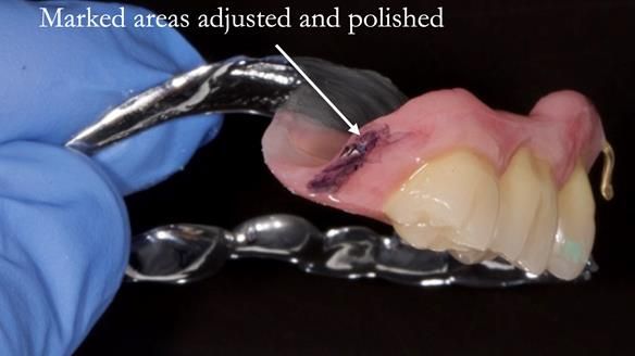 Finlay's Newsletter 64 case study - provision of a Kennedy class 2 metal based Scandinavian RPD for Ian