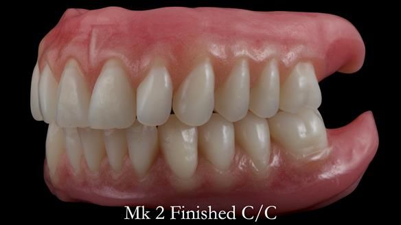 Replacing Madeline’s Complete denture FULL PROTOCOL
