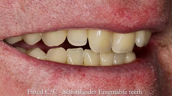 Complete denture Class II div 2 deep overbite Newsletter 39