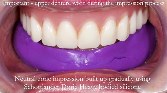 Replacing Madeline’s Complete denture FULL PROTOCOL