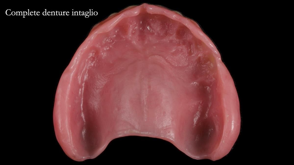 Fin’s Newsletter 88 — Complete dentures - full protocol… he rearranged his own teeth!