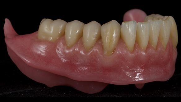 Newsletter 80 - Gordon’s dentures: the one case in 1,000 where my technique failed