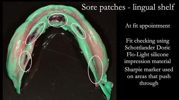 Newsletter 75: Marion’s case - Step-by-step complete denture workflow