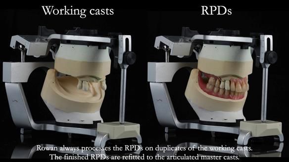 Finlay's Newsletter 59 Ultra hard partial dentures made for Gill