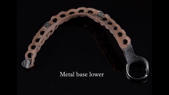 Finlay's Newsletter 59 Ultra hard partial dentures made for Gill