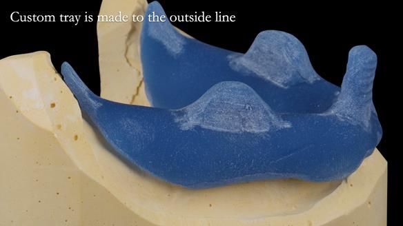 Newsletter 53 showing the making and fitting of ultra life-like dentures for Valena