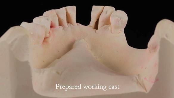 Newsletter 54 case presentation upper complete denture and lower Scandinavian designed hygienic partial denture for David