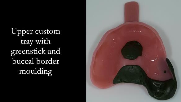 Newsletter 51 Managing Anne’s failing dentition with distal extension base RPD/Splint FULL PROTOCOL