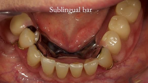Finlay's Case Study Newsletter 40 - Immediate Mk 1 RPD to Definitive Mk 2 RPD - full protocol