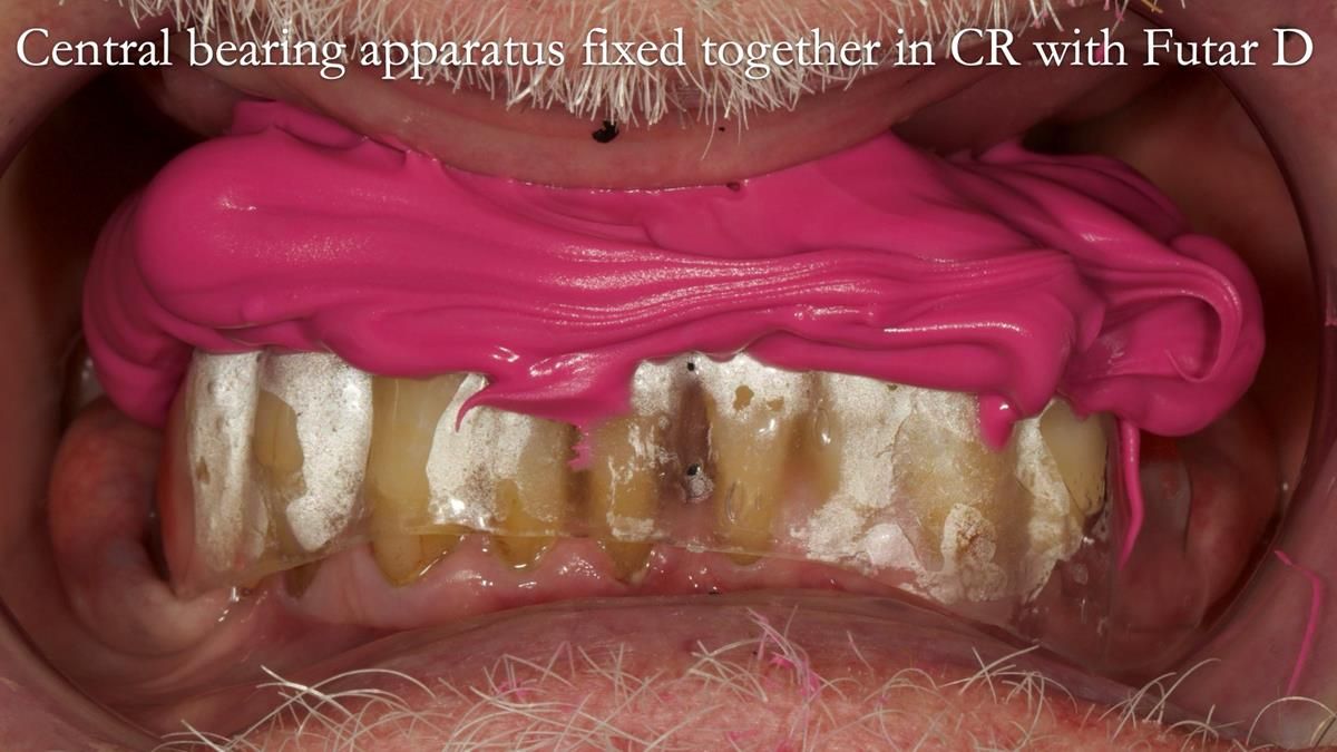 Newsletter 87 – Father Peter: A Partial Denture that needed Minor Miracle