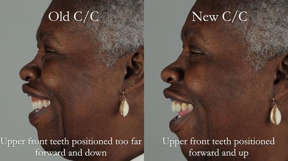 Newsletter 53 showing the making and fitting of ultra life-like dentures for Valena