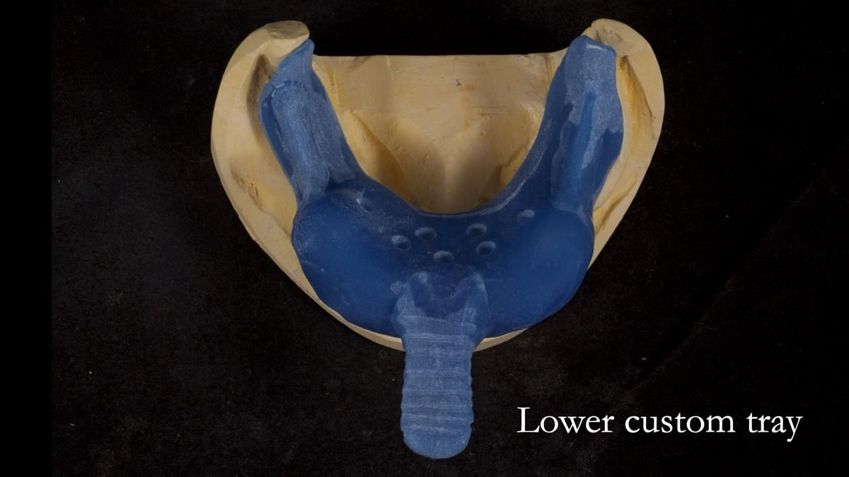 Newsletter 87 – Father Peter: A Partial Denture that needed Minor Miracle