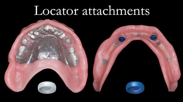 Newsletter 57 showcases the making and fitting process of implant-supported complete dentures for Alisdair