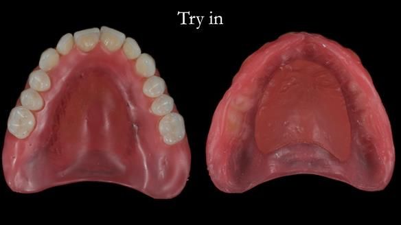 Newsletter 68 Restoring Jan’s Smile: Complete Dentures Inspired by Her Daughter’s Teeth - Post Mouth Surgery