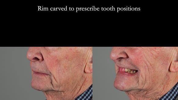 Managing Edgar “THE SCEPTIC” with an RPD/Splint FULL CASE