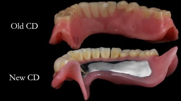 Finlay's Newsletter 62 provision of extractions and metal based complete dentures for Rafique