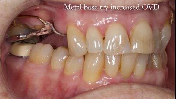 Finlay's Newsletter 60 Sylvia's upper Kennedy Class 2 Mod 1 metal based upper RPD