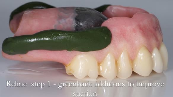 Newsletter 54 case presentation upper complete denture and lower Scandinavian designed hygienic partial denture for David