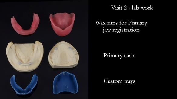 Newsletter 57 showcases the making and fitting process of implant-supported complete dentures for Alisdair
