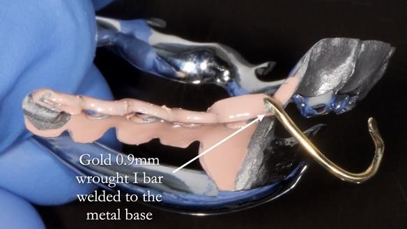 Finlay's Newsletter 61 provision of a lower unilateral free end saddle metal based partial denture for Joyce