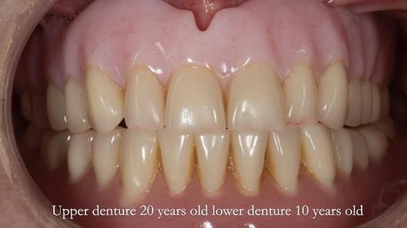 Newsletter 75: Marion’s case - Step-by-step complete denture workflow