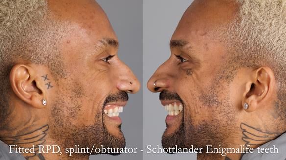 Upper metal base partial denture/occlusal stabilisation splint/obturator - full protocol