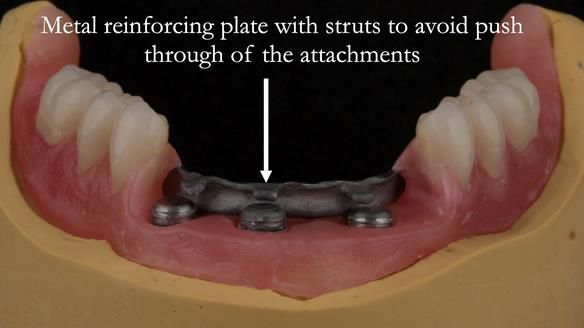 Reinforcement to implant supported dentures is crucial to reduced breakages