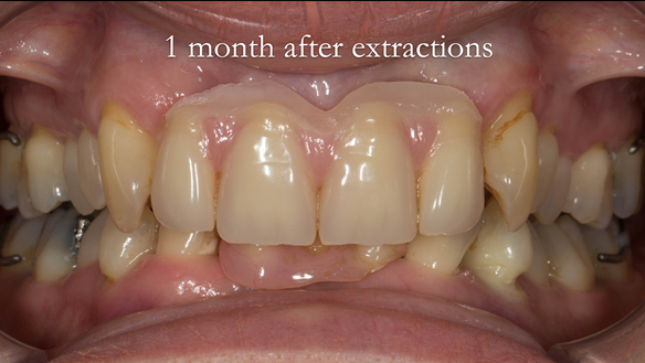 Figure 45 Review 1 month after extractions. Gap has formed