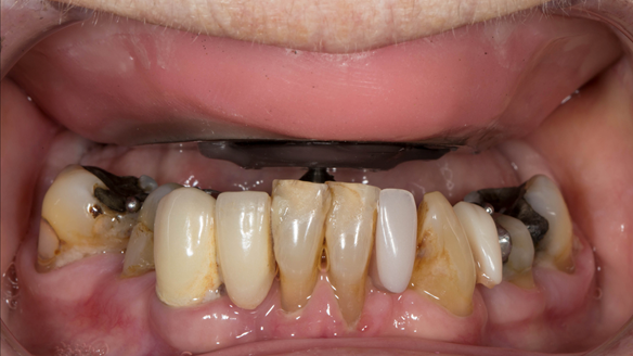 Figure 84 Central bearing apparatus guided into a countersink hole on the maxillary plate.