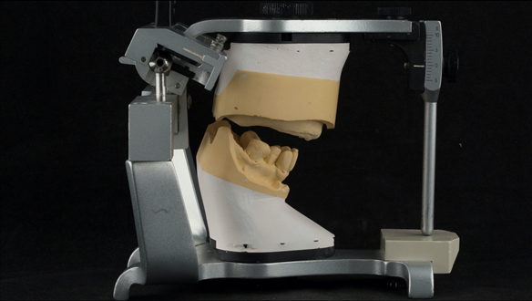 Figure 89 Facebow and CR record (central bearing apparatus) are using to mount the definitive casts on the articulator (Denar Mk 2)