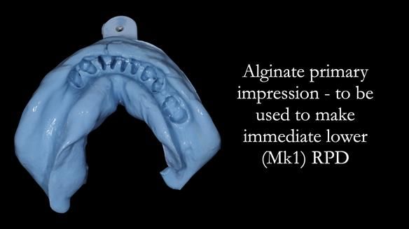 Newsletter 54 case presentation upper complete denture and lower Scandinavian designed hygienic partial denture for David