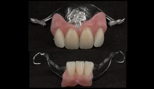  Figure 73 Finished definitive partial dentures