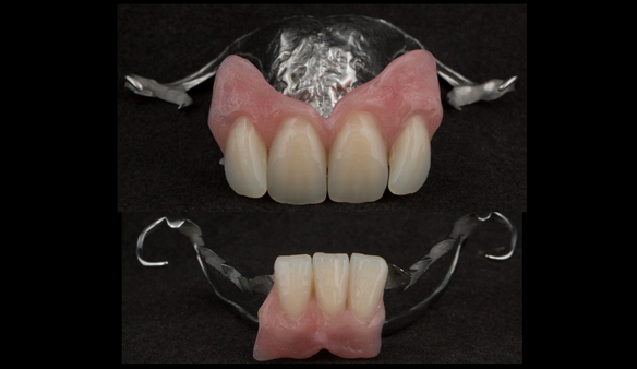 Figure 73 Finished definitive partial dentures
