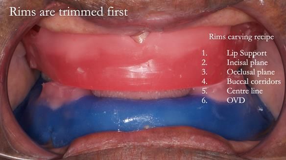Newsletter 53 showing the making and fitting of ultra life-like dentures for Valena