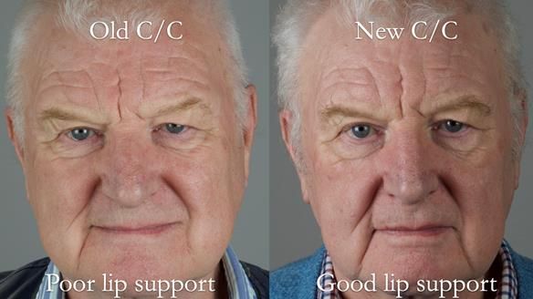 Newsletter 57 showcases the making and fitting process of implant-supported complete dentures for Alisdair