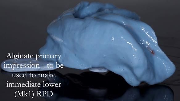 Newsletter 54 case presentation upper complete denture and lower Scandinavian designed hygienic partial denture for David