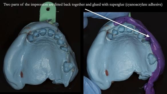 Finlay's Case Study Newsletter 40 - Immediate Mk 1 RPD to Definitive Mk 2 RPD - full protocol