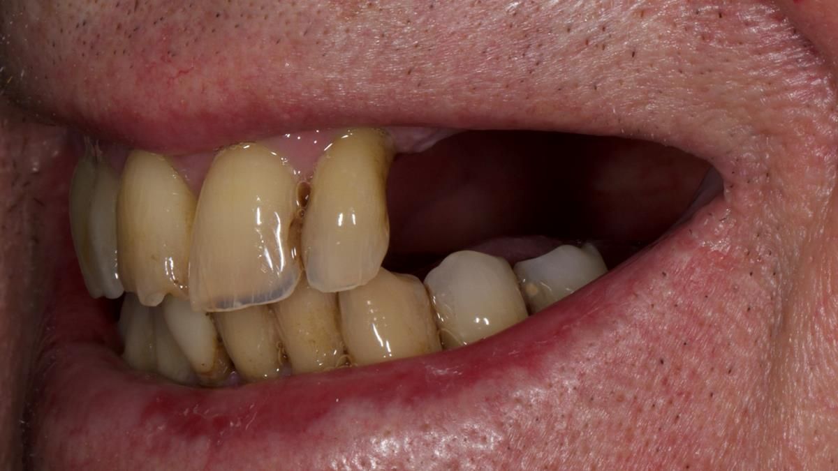 Newsletter 89 – Simon: A Challenging Kennedy Class II Division 1 Upper CoCr Partial Denture with a High Smile Line