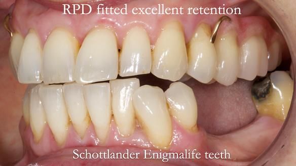 Newsletter 56 showing the making and fitting of a bilateral free end saddle upper removable partial denture (RPD) for patient with pemphigus