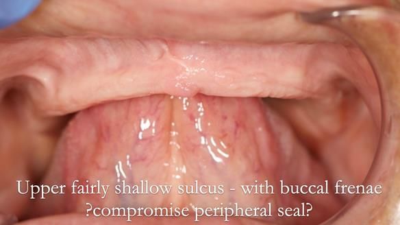 Managing poor implant positioning with complete dentures and Locator attachments - full protocol Newsletter 41